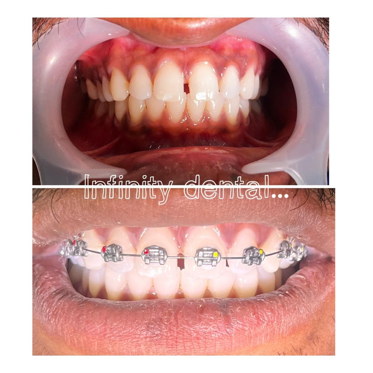 Smile Makeover